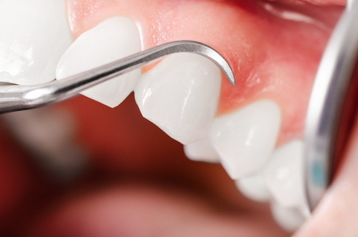 A mouth that has just had Scaling and Root Planing performed at Hunter Dental Care in Portland, OR