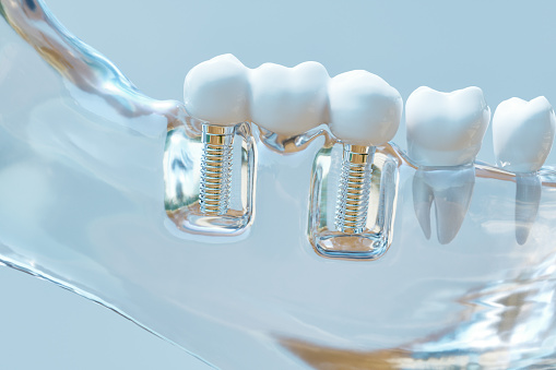 an example of multiple tooth implants Hunter Dental Care in Portland, OR an example of multiple tooth implants Hunter Dental Care in Portland, OR